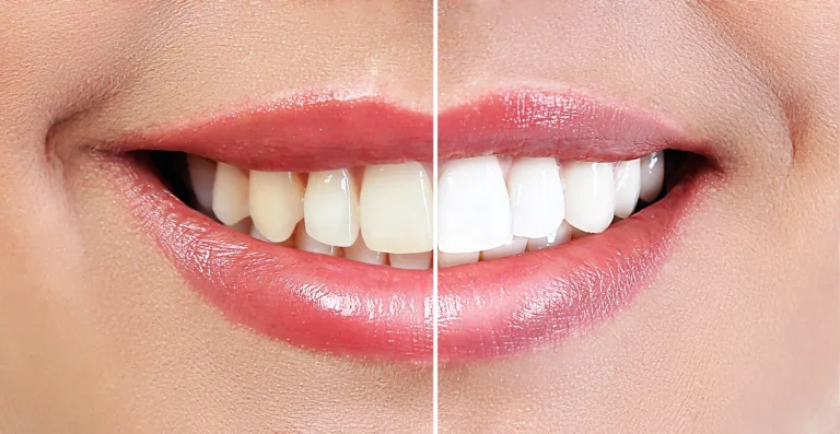 Cosmetic dentistry