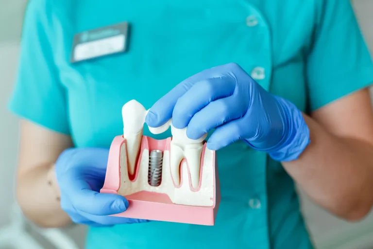 Dental implants
