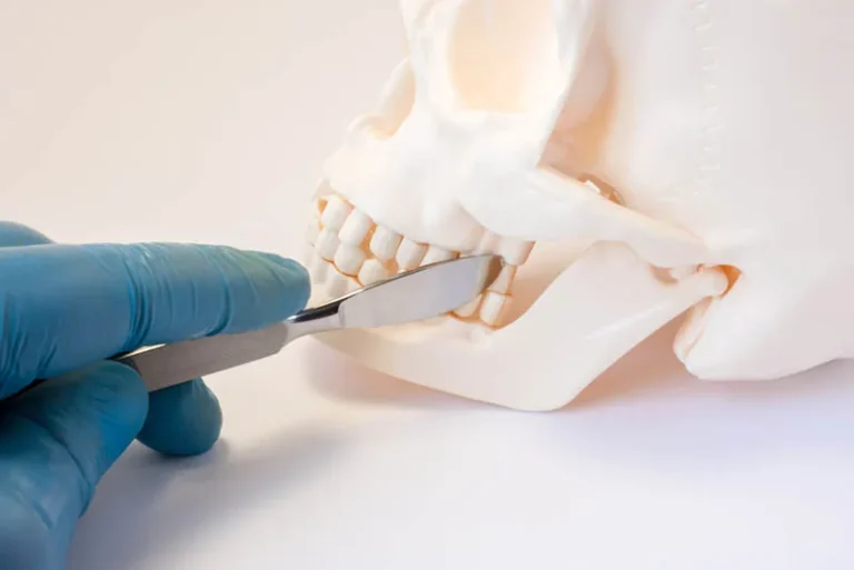 Implants and wisdom teeth